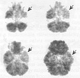 Az epileptog�n f�kusz az
FDG-pometabolikus ter�letk�nt �br�zol�dik