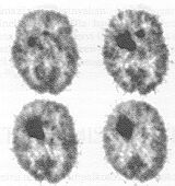 Az agytumor a k�rnyezet�n�l jobban halmozza az
FDG-t